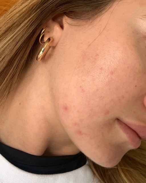 A woman deciding which pimple patches to use?