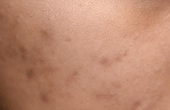 A close up of dark spots on a bum