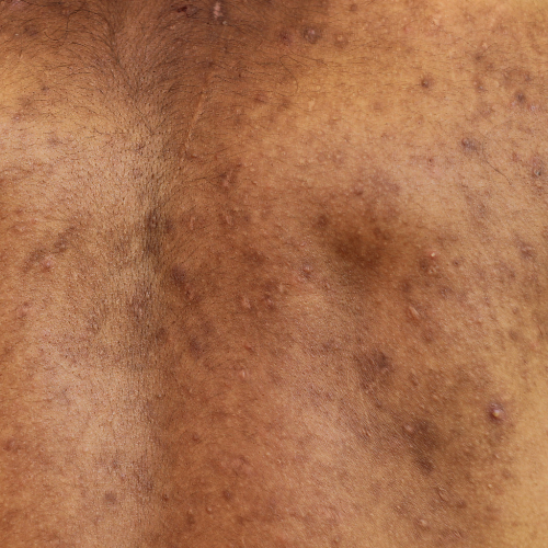 A clinical close-up showing red, inflammatory pimples on back and clogged pores, illustrating the typical appearance of severe back acne (bacne)