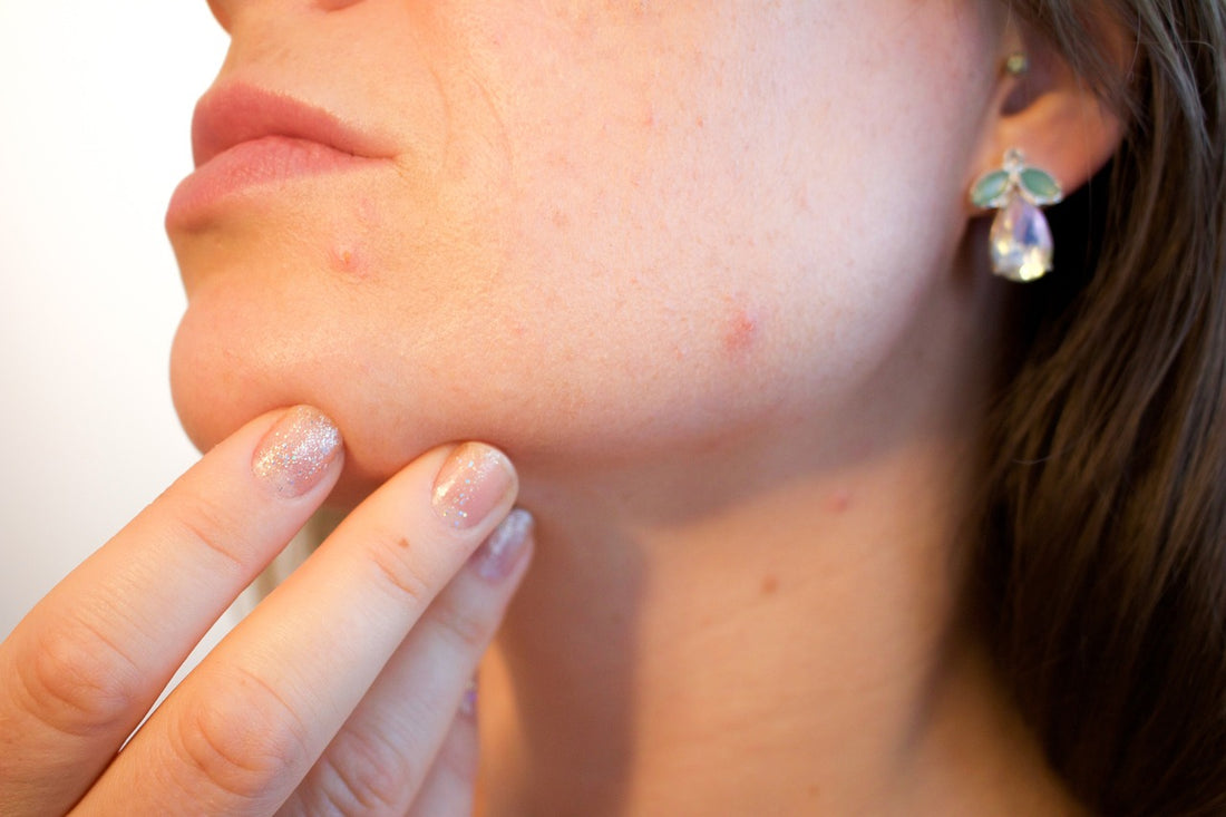 A woman getting rid of under the skin pimples