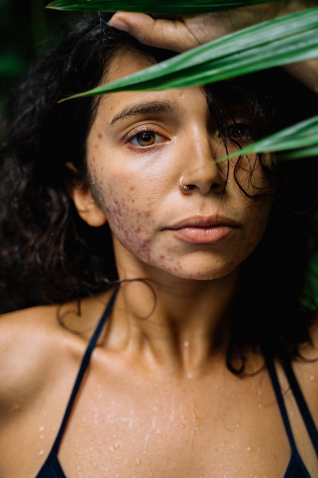 A photo of a lady with hormonal acne