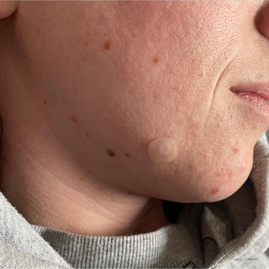 A girl with pimples on chin