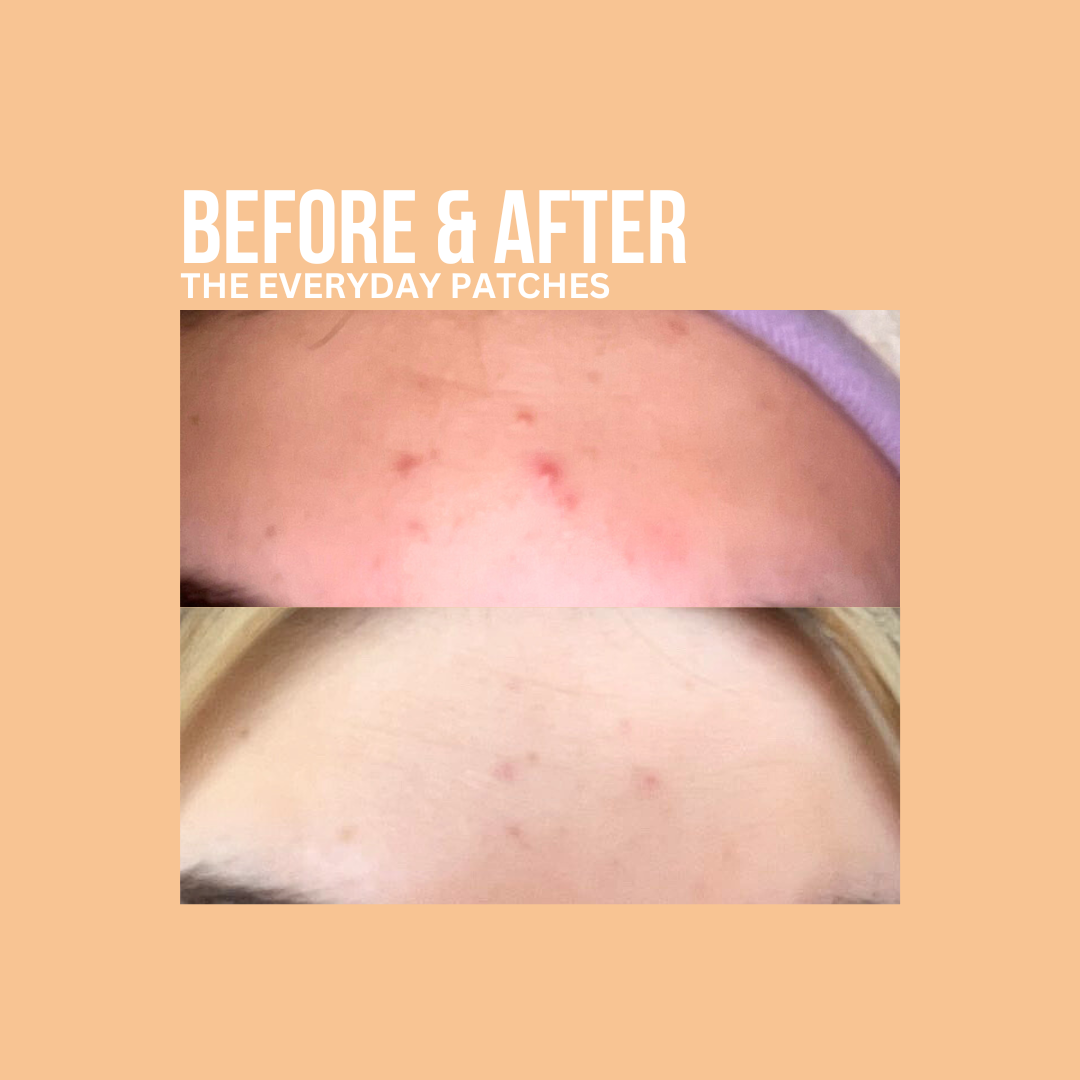 Clear Pimple Patches Before And After