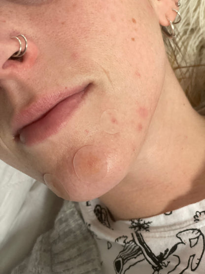 A girl wearing microneedle pimple patches