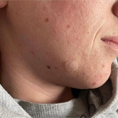 A girl wearing overnight pimple patches