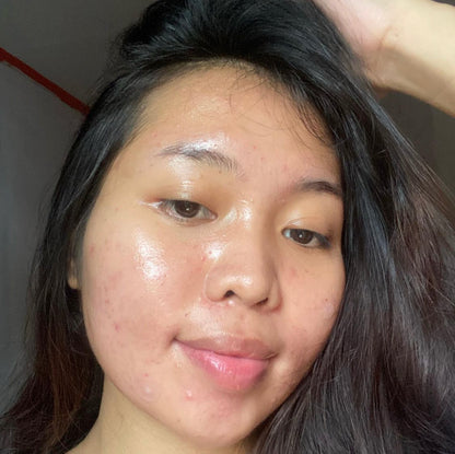 A girl wearing overnight pimple patches